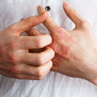 eczema dermatitis