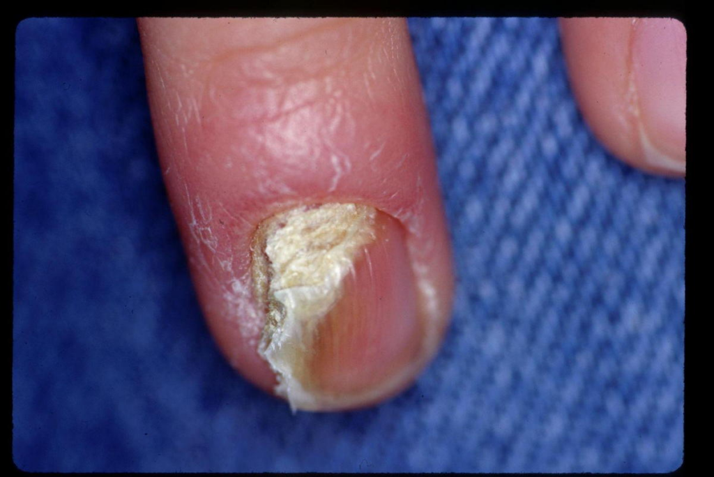 Nail Psoriasis Phoebe Rich, MD